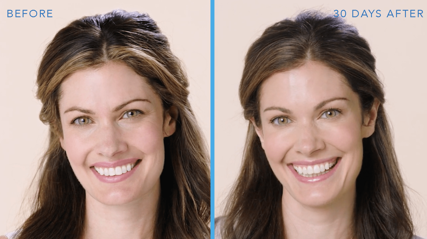 Botox for crow's feet before and after results in Millburn, NJ